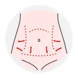 Reprezentare grafică a intervenției de abdominoplastie