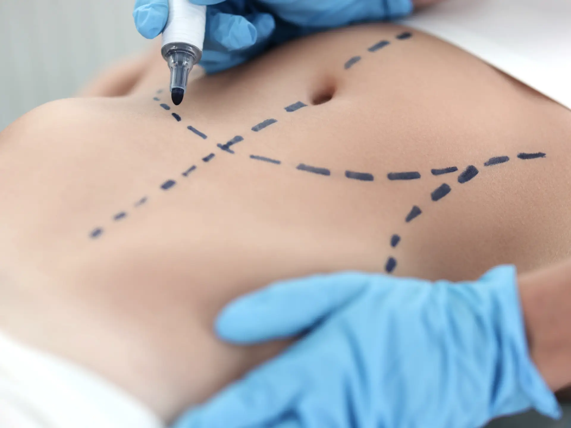 Pacientă în consultație preoperatorie pentru Mommy Makeover