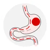 Reprezentare grafică a intervenției cu balon gastric