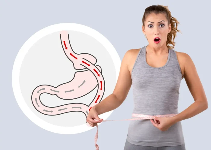 Gastric Bypass