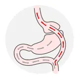 Reprezentare grafică a intervenției de gastric bypass