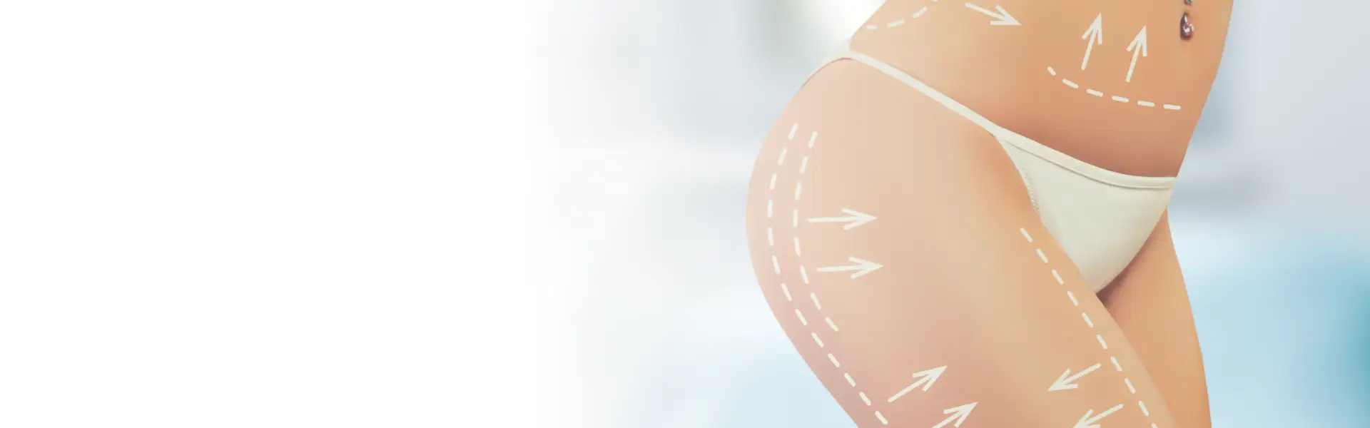 Abdominoplastie