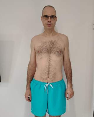Florin după gastric sleeve