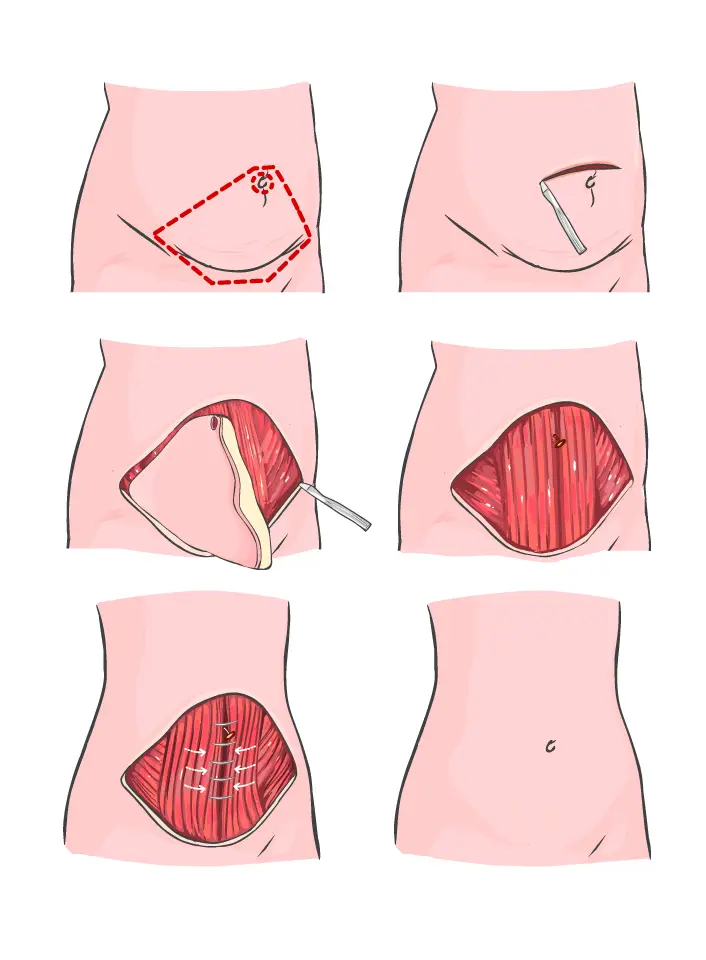 Reprezentare grafică a procedurii medicale de abdominoplastie