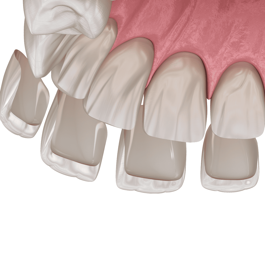 Laminate dentare